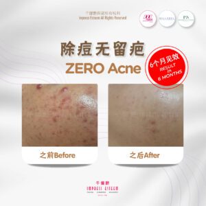 Zero Acne, Results in 6 months 除痘无反弹，6个月见效